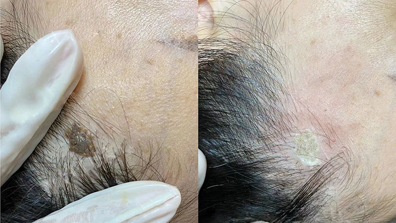 疤痕修复加盟价格